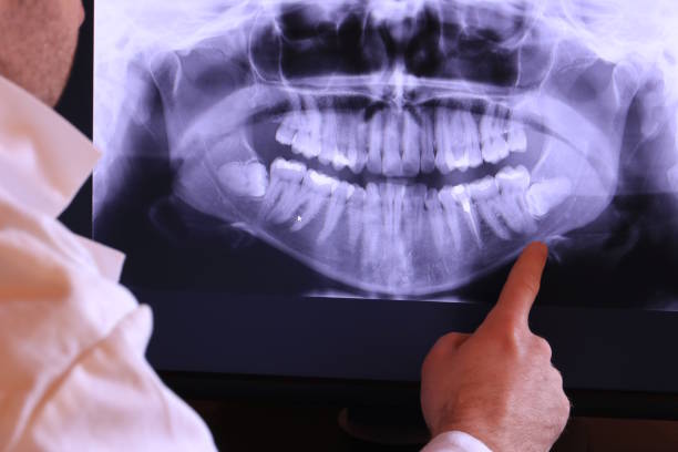 Best Root Canal Emergency Dentist  in Glencoe, AL